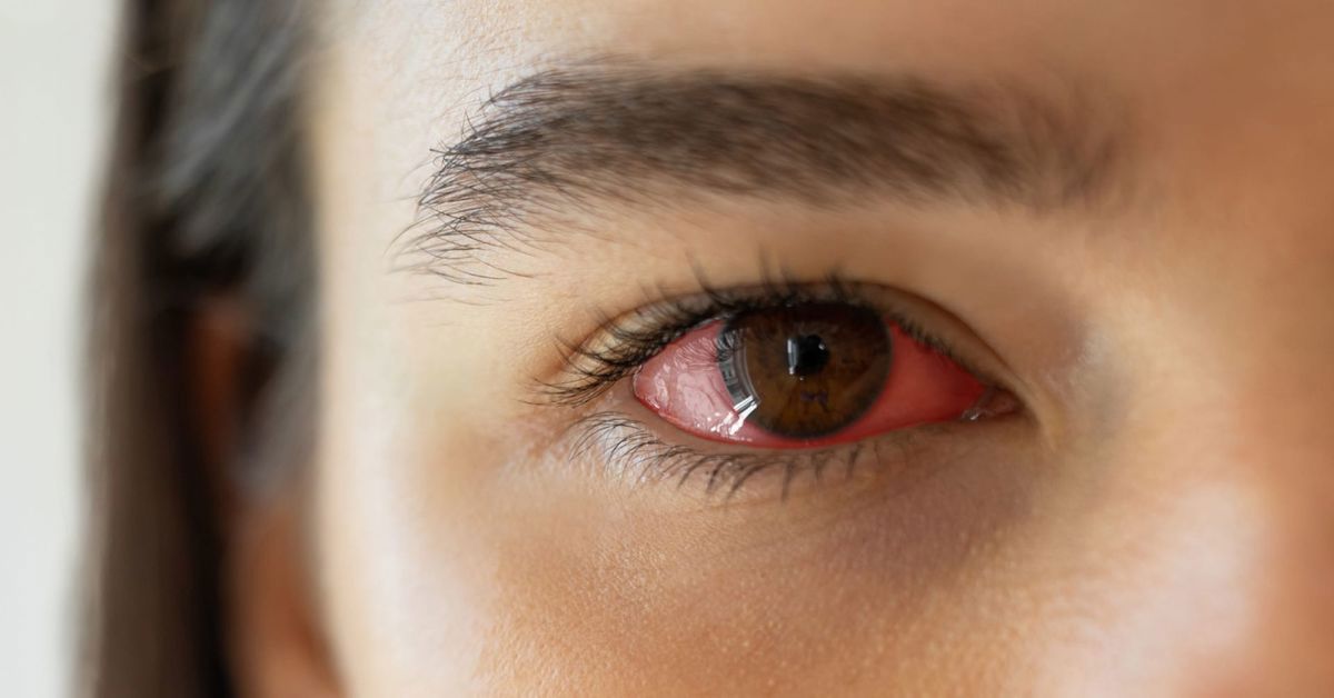 What is Eye Pressure?