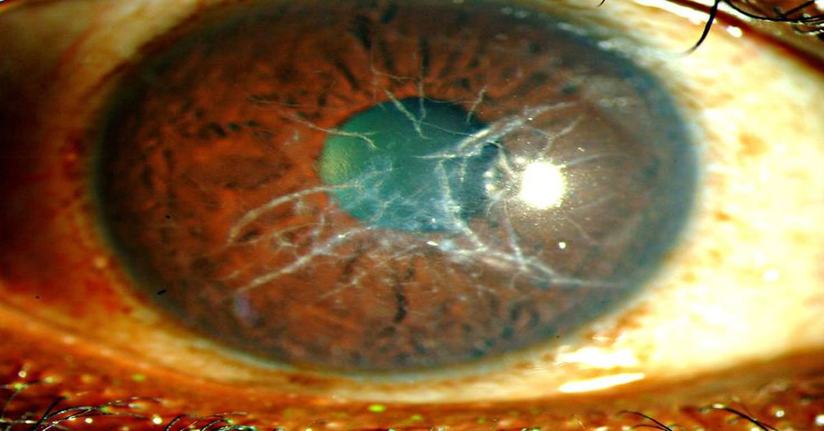 What is a Corneal Ulcer?