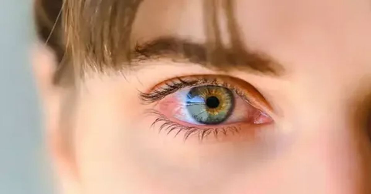 What is Uveitis Disease?