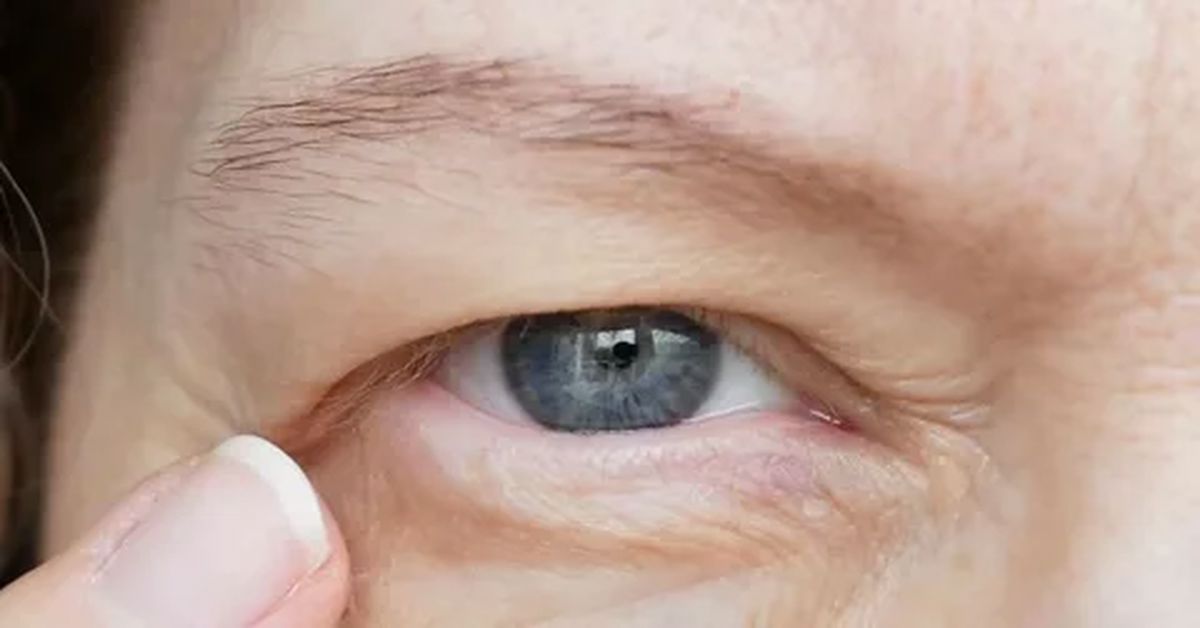 Drooping Eyelids