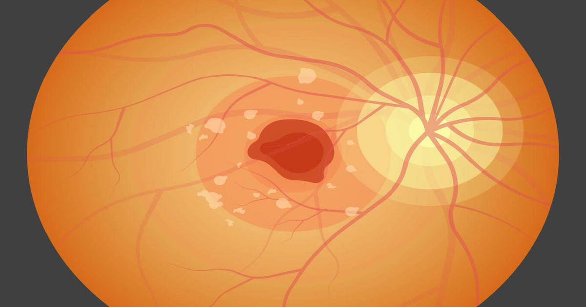 Macular Degeneration