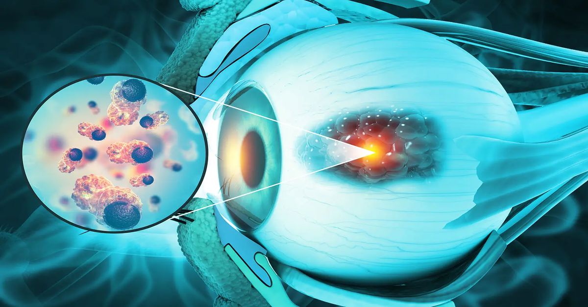 Eye Cancer