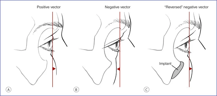 Infraorbital Rim Implant